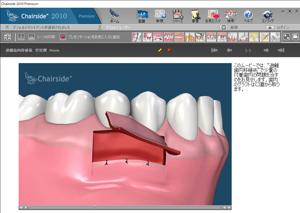 2 遊離歯肉移植術 受容側 - インプラント専門の歯科クリニック