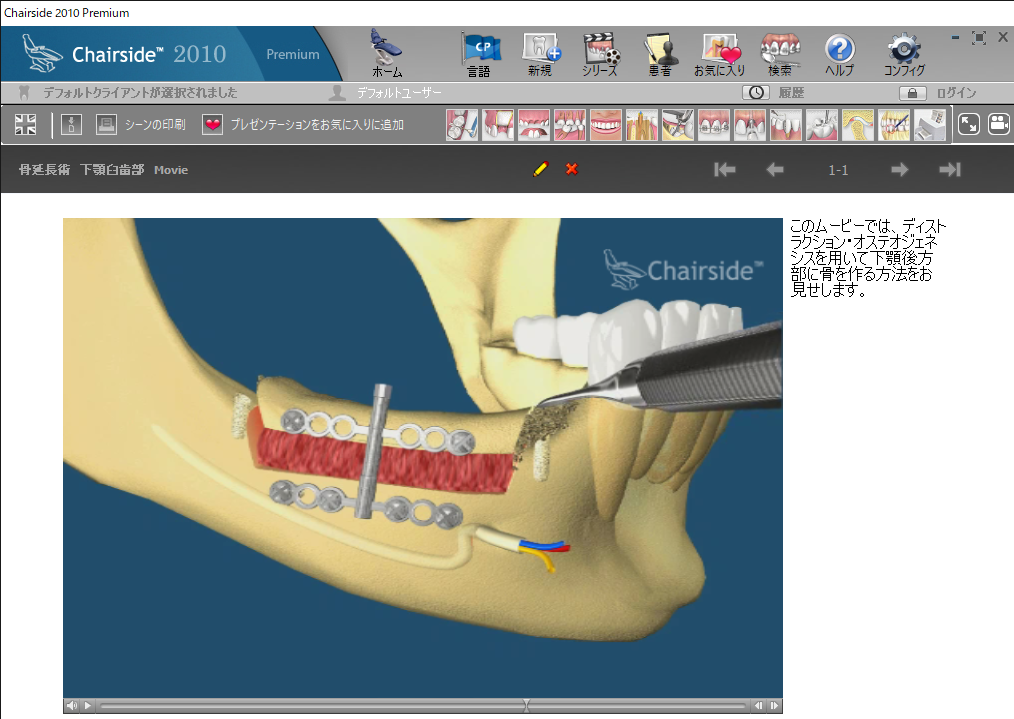 3骨吸収と移植 J骨延長術 下顎臼歯部 - インプラント専門の歯科 